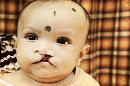 Cleft | Lippen Kiefer Gaumen Spalte