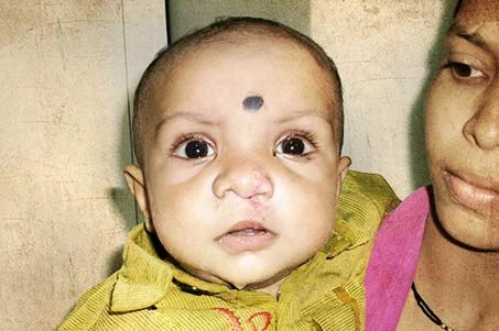 Cleft | Lippen Kiefer Gaumen Spalte