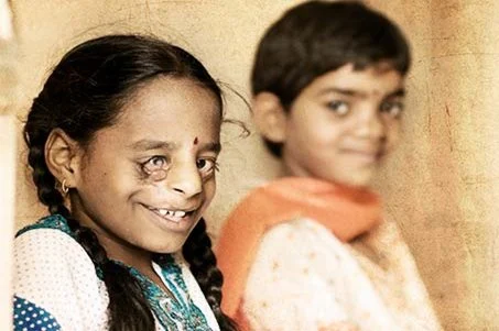 Ein Mädchen mit einer besonderen Gesichtsstruktur lächelt in die Kamera, während ein Junge im Hintergrund schaut.