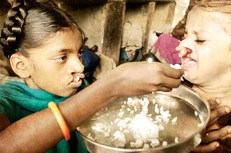 Cleft | Lippen Kiefer Gaumen Spalte