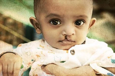 Ein Baby mit einer Lippen-Kiefer-Gaumenspalte, das in den Händen eines Erwachsenen gehalten wird.